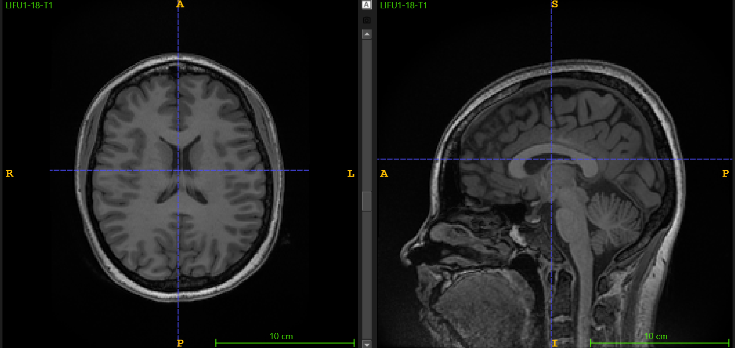Brain MRI scan