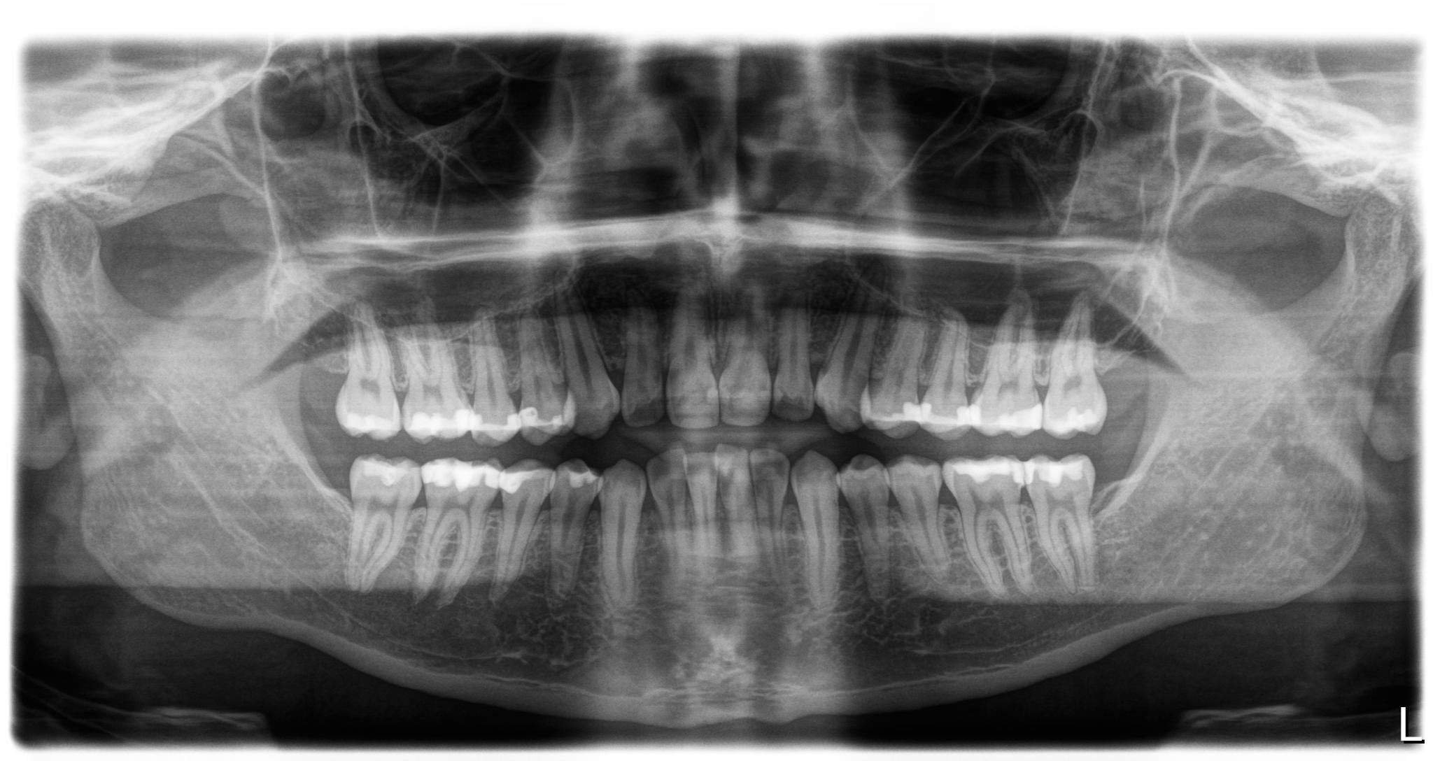 Dental panoramic X-ray